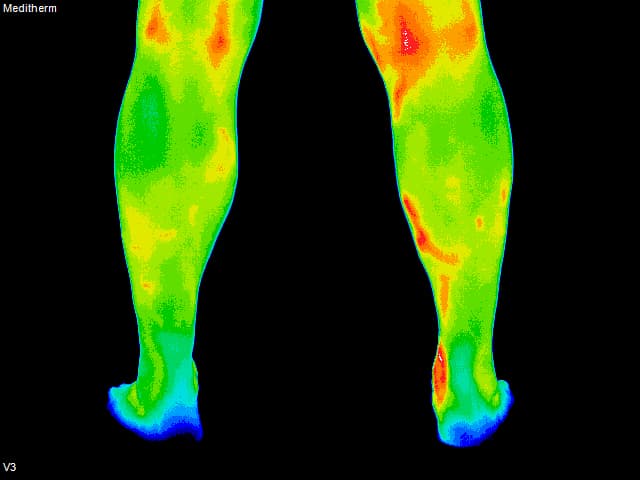 Blood Clot - Back of Leg