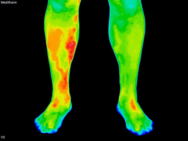 Blood Clot - Front View