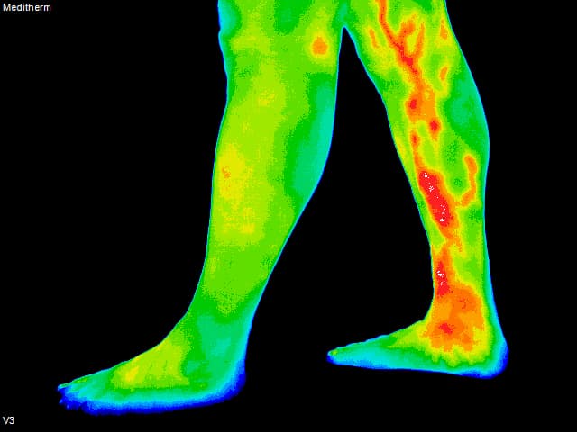 Blood Clot - Inside View